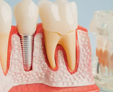 Implant Tooth Solutions in Dalton, GA | Expert Dental Care