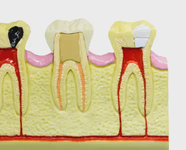Rotten Teeth? Expert Solutions
