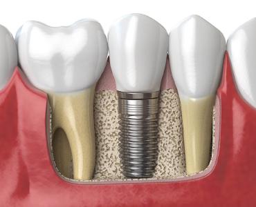Dental Implants in Dalton GA